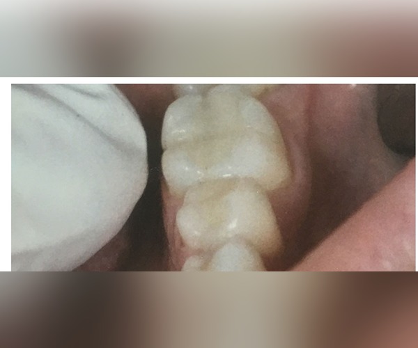 before-and-after-cavities-2