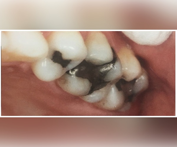 before-and-after-cavities