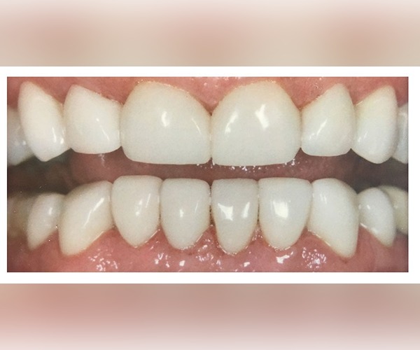 before-and-after-dental-work-san-diego