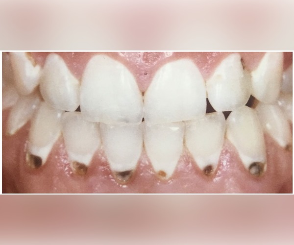 before-and-after-dentist-cavity-repair